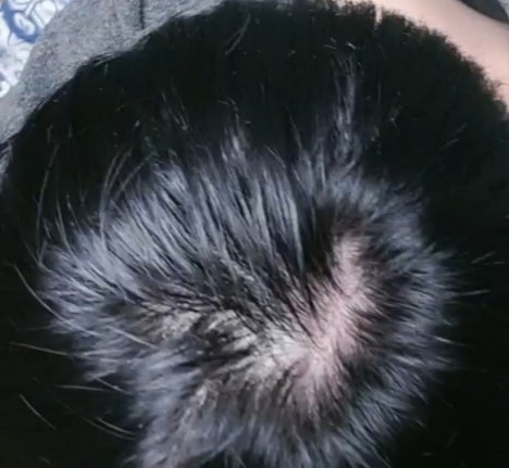 바로피나 복용 8개월차