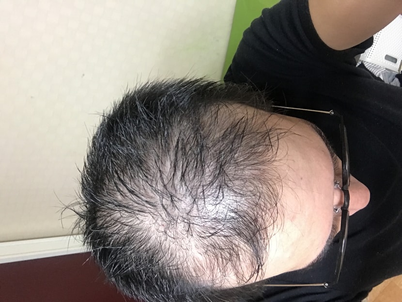 프로스카 6개월 먹었는데 아무효과 없을때.. 