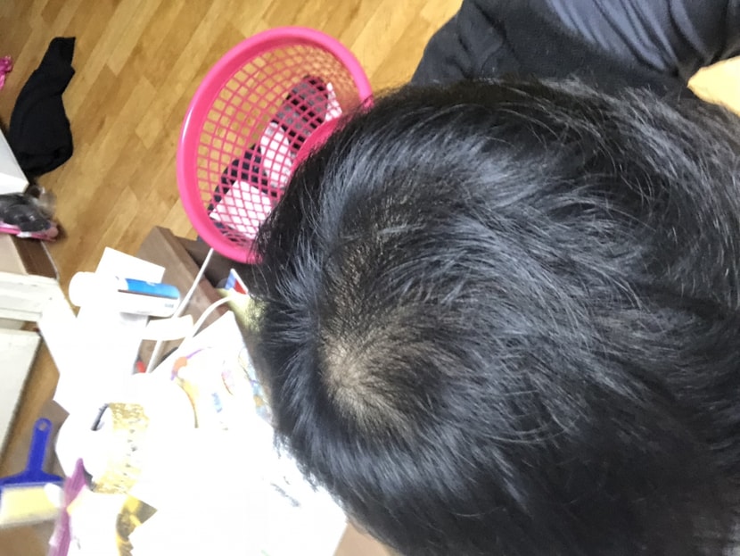 아보다트랑 미녹시딜 후 1년