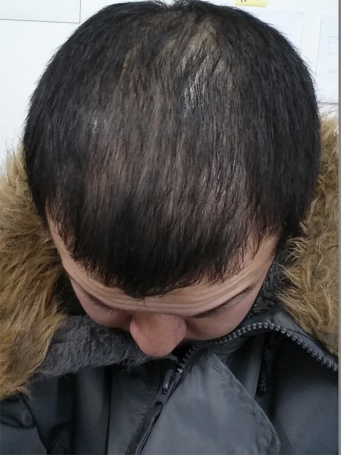 두달이면 충분. 모나드정 2개월 효과 + 이후에 약을 끊고 8개월이 지난 현재