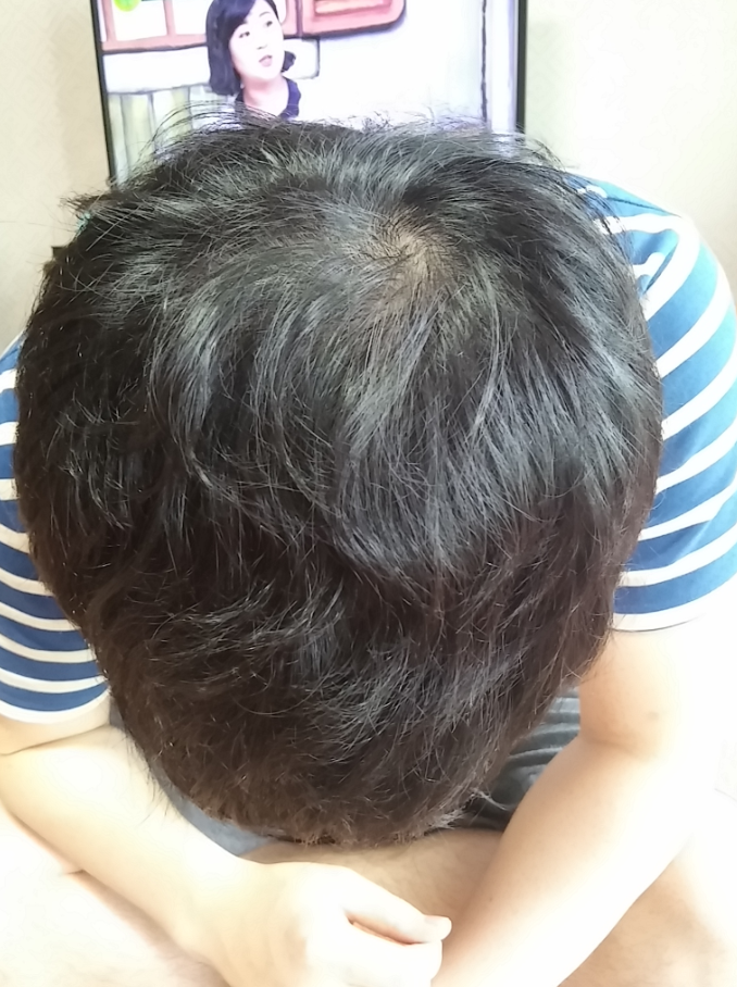 피나스테리드 8개월차