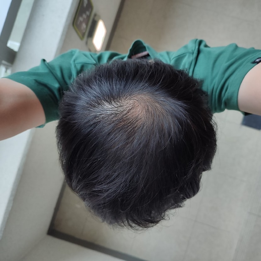 조합약복용 6개월후