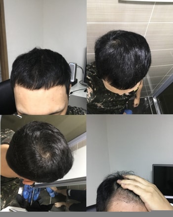 아보다트+미녹시딜 10개월