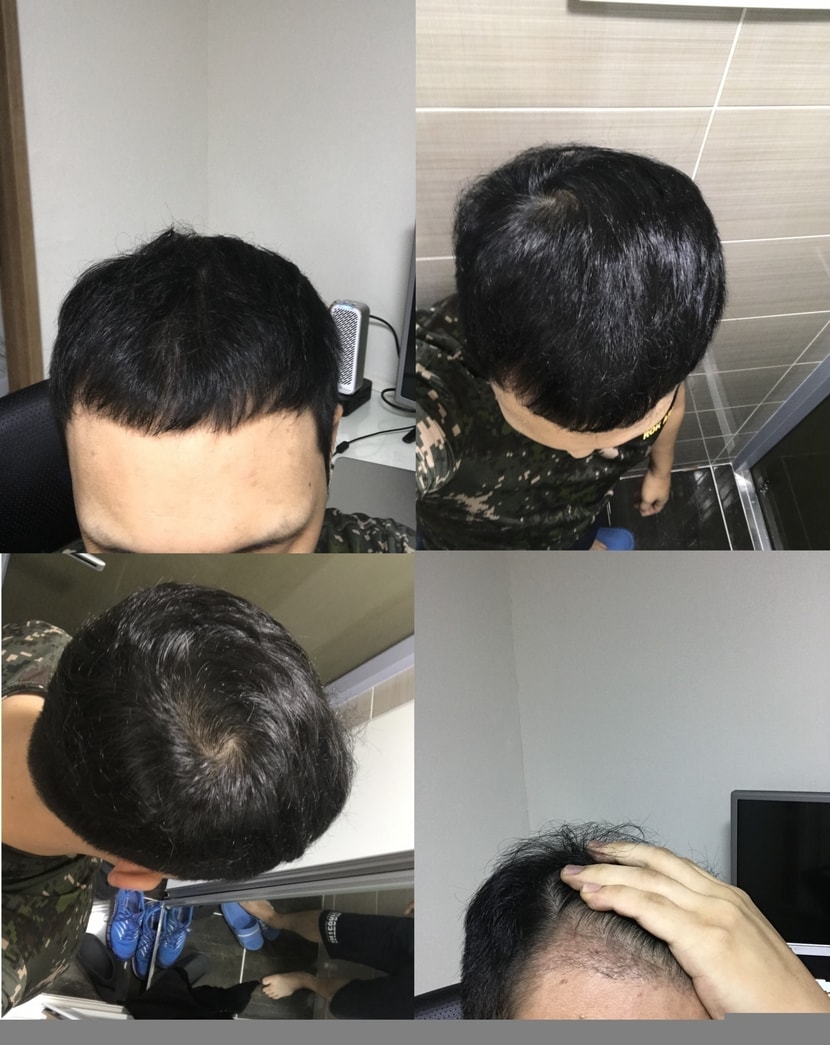아보다트+미녹시딜 10개월