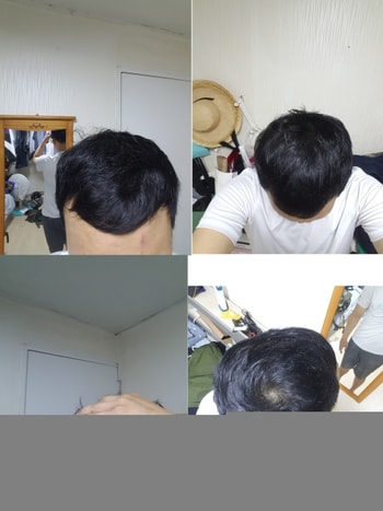 아보다트+미녹시딜 6개월