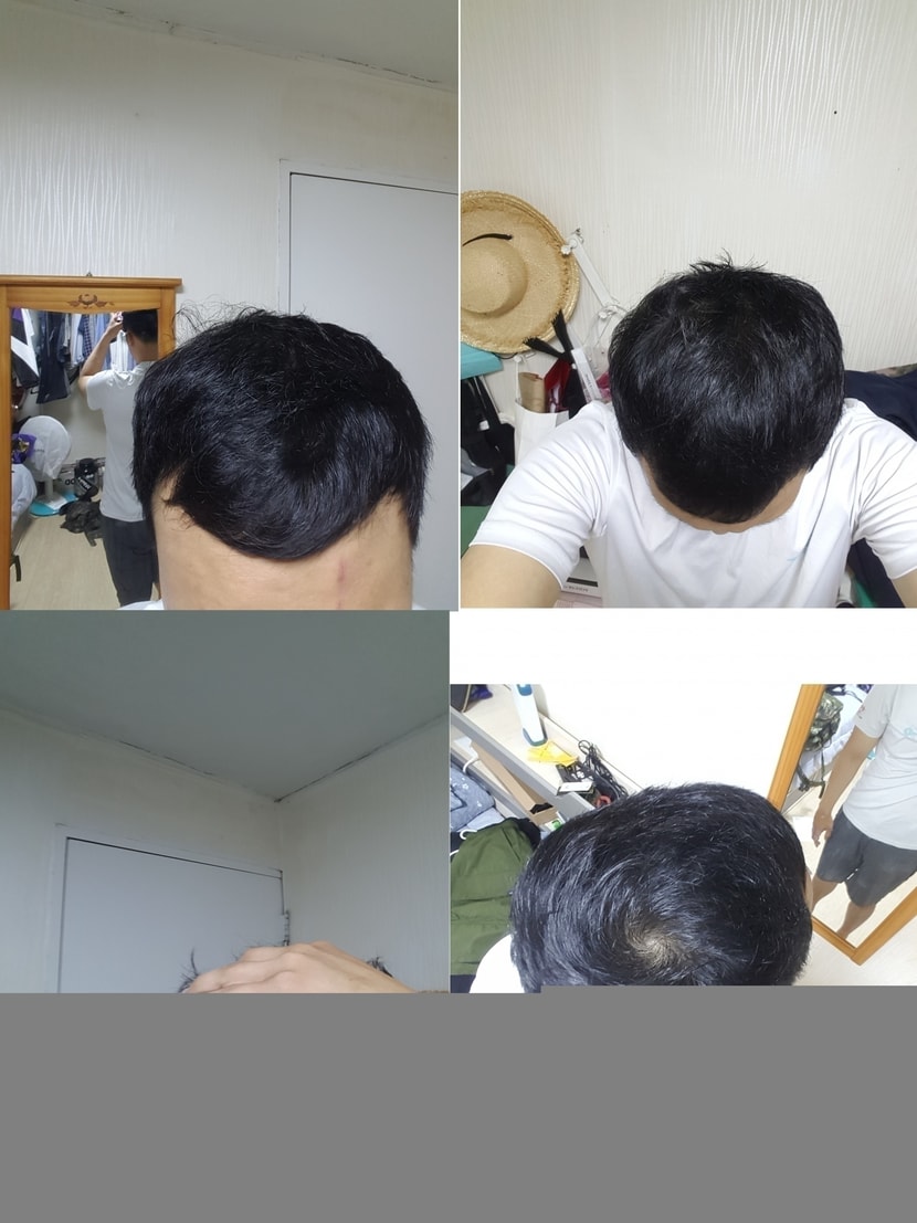 아보다트+미녹시딜 6개월
