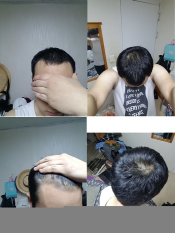 아보다트+미녹시딜 2개월