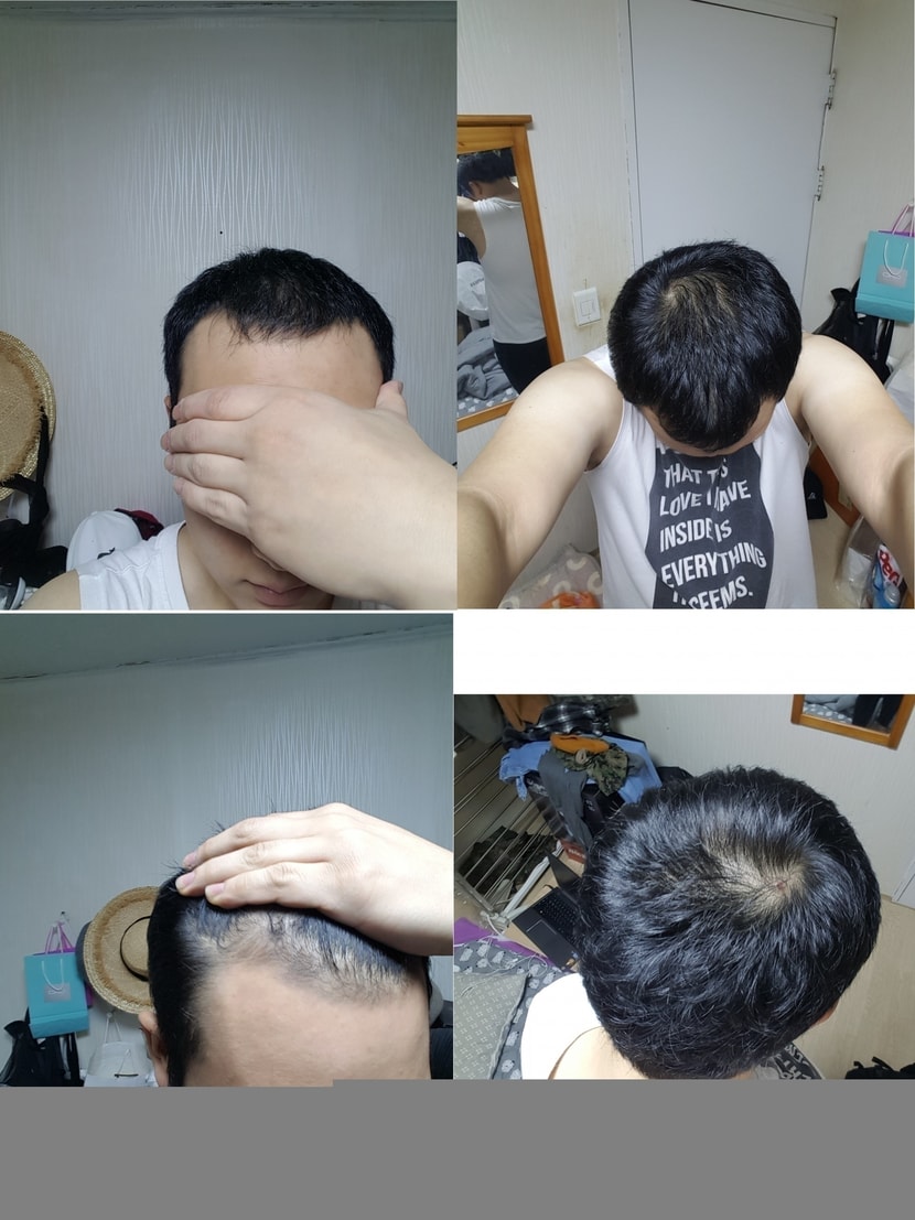 아보다트+미녹시딜 2개월