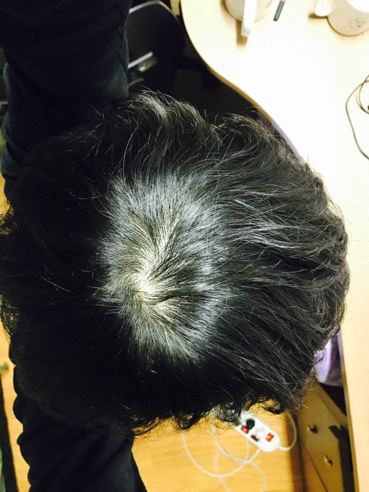 프페 계열 2달 복용 후기