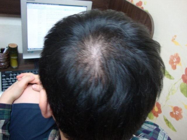 It's been 8 months since I started Pina. The effect of the medicine is slowly coming up