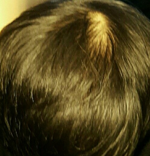 普罗佩西亚九个月后期