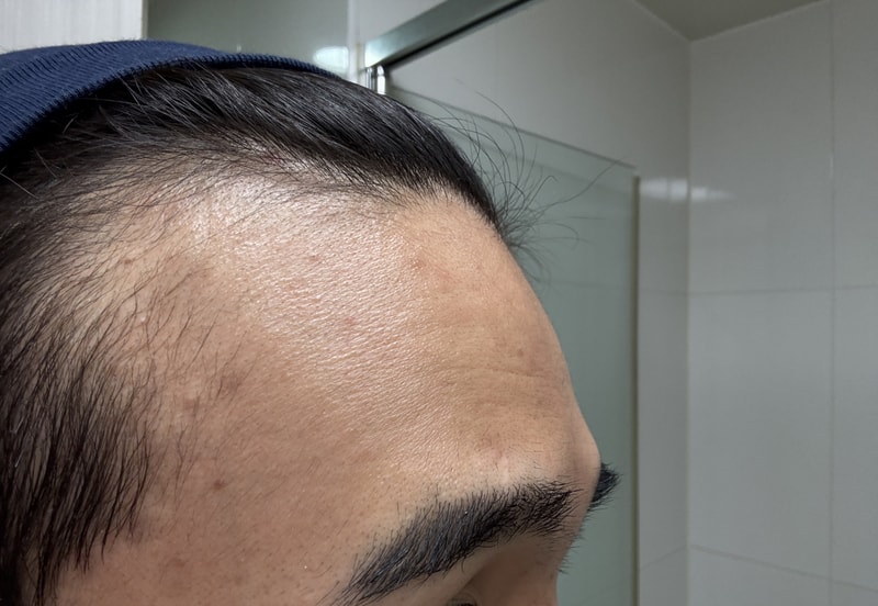 피나스테리드 처방받고 왔습니다.