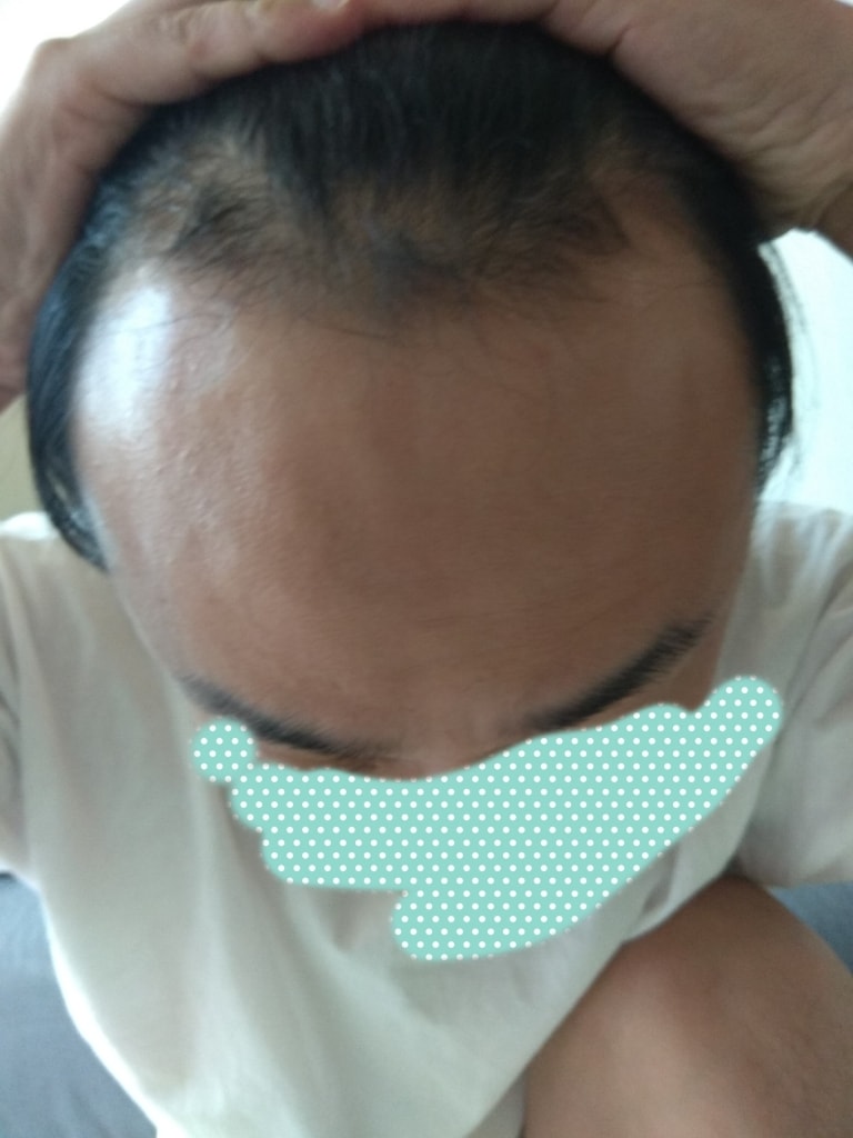 2018년10월 복용전