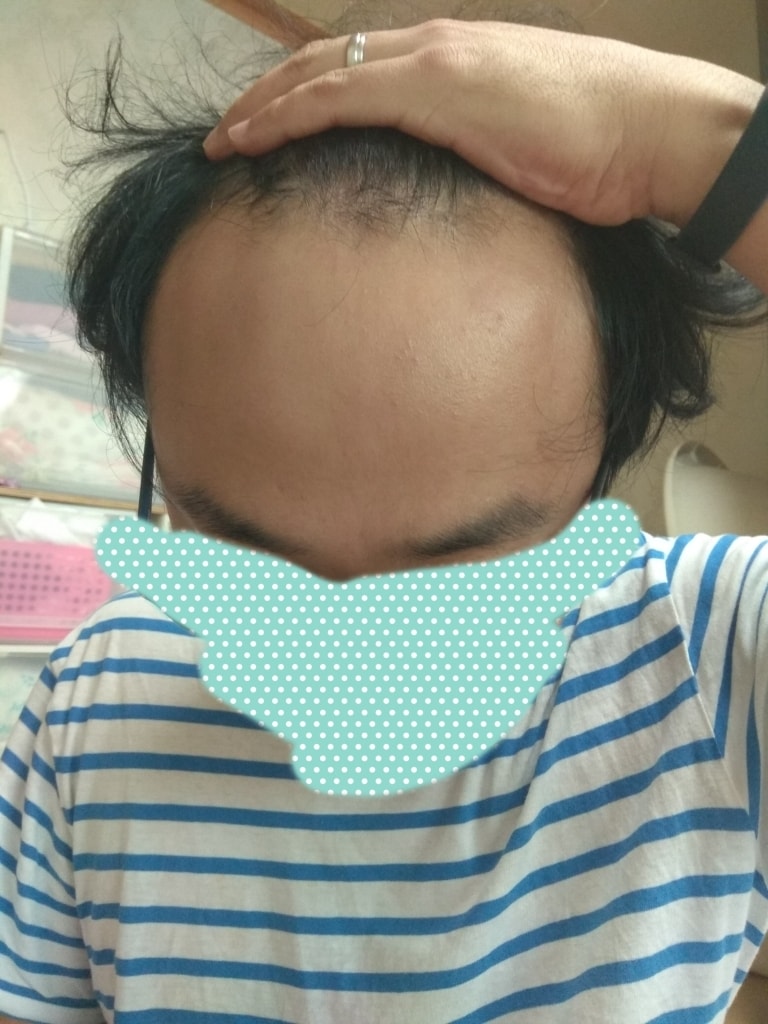 2018년 11월 피나로 복용 1개월
