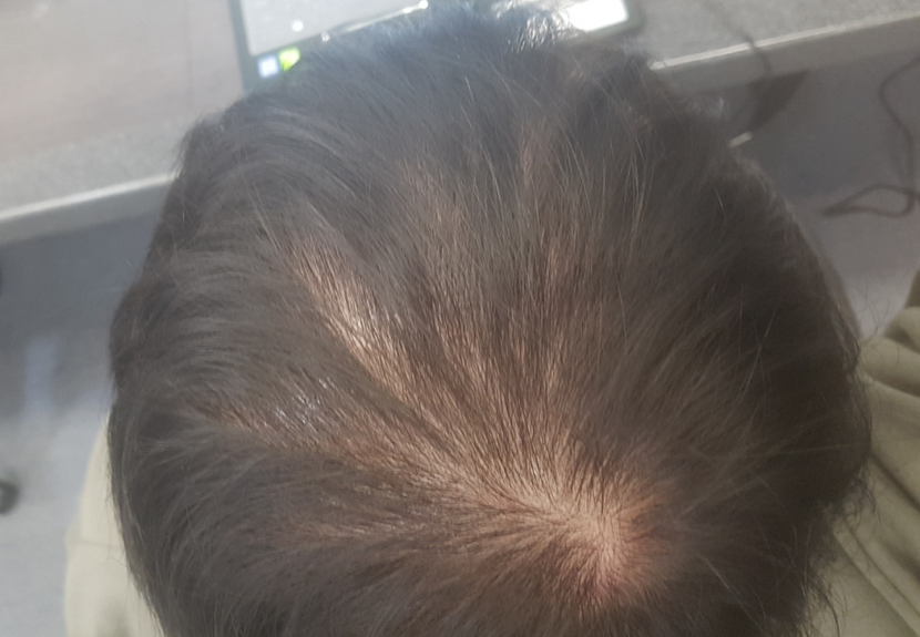 피나스테리드 복용 33일차