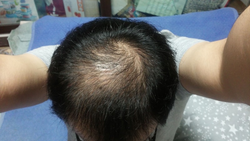 약 복용한지 9개월 조금 넘었네요