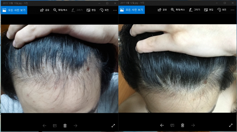 Abodat 12 个月后期（添加垂发前后照片）