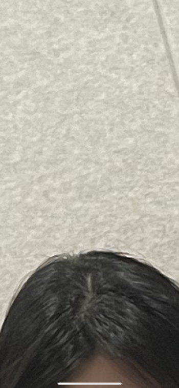 미녹시딜정으로 조금 채워졌던상태