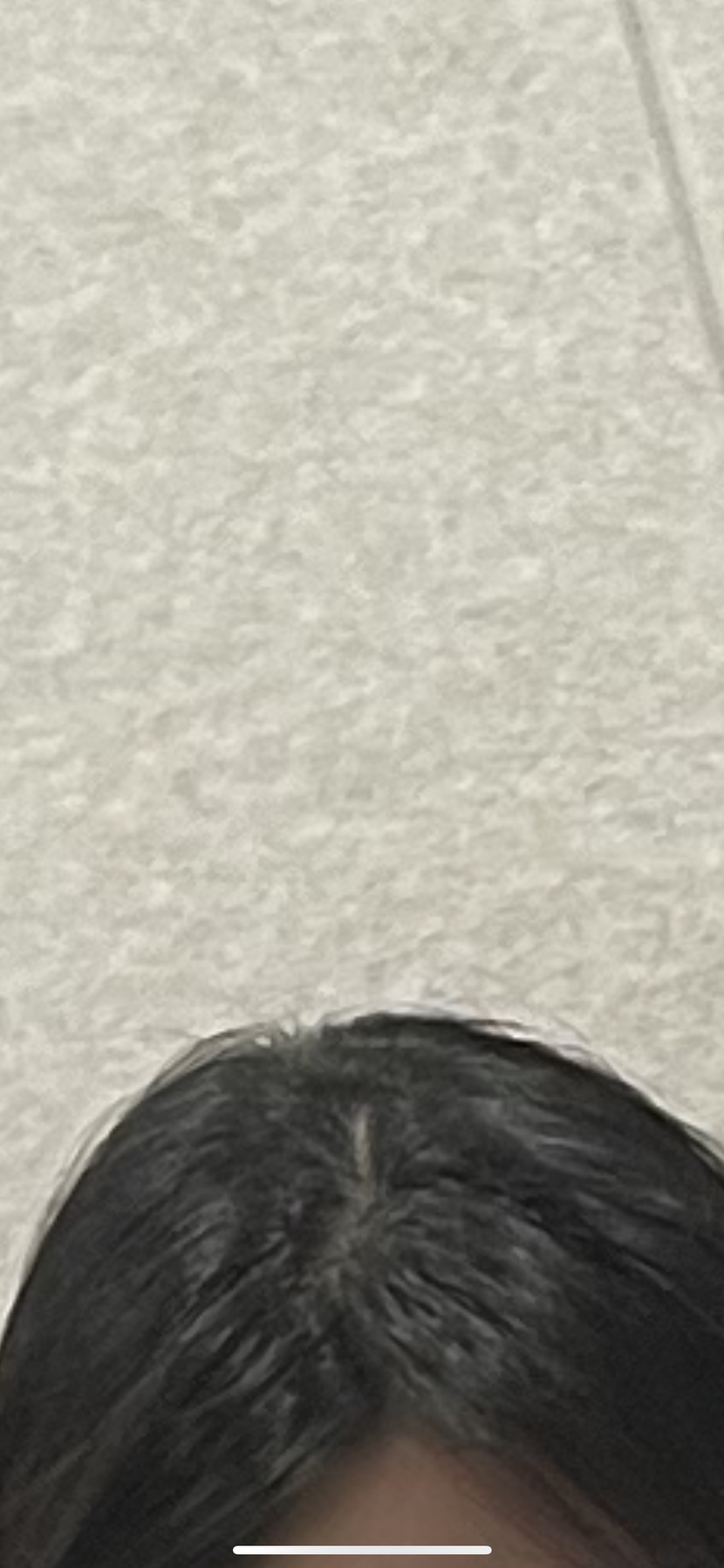 미녹시딜정으로 조금 채워졌던상태