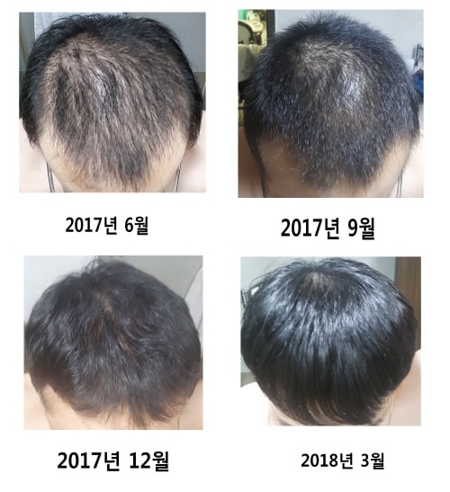 유로스칸 1개월 + 아보다트+미녹시딜 8개월~