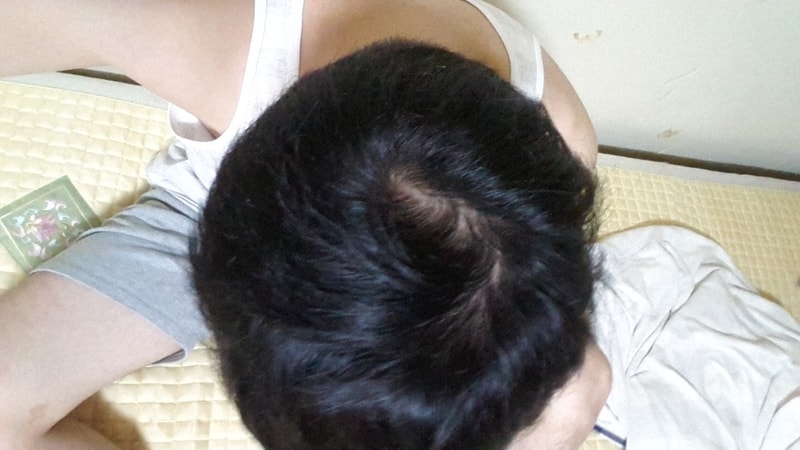 20대 정수리  프로스카 5개월 후기