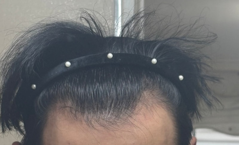 피나스테리드+미녹시딜정(반알) 2달차 후기