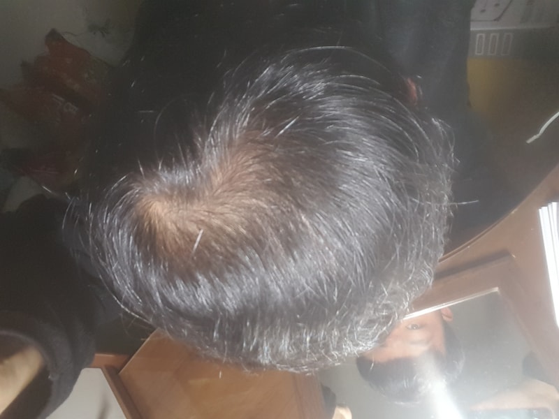 Propecia 7个月+Minoxidil 10周（两个半月）
