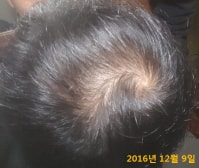 24살 프로페시아 5개월 + 미녹시딜 6주