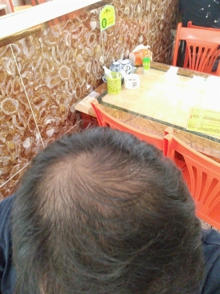 4ヶ月薬服用後2ヶ月休んで2ヶ月薬服用後4ヶ月服用していない体験談