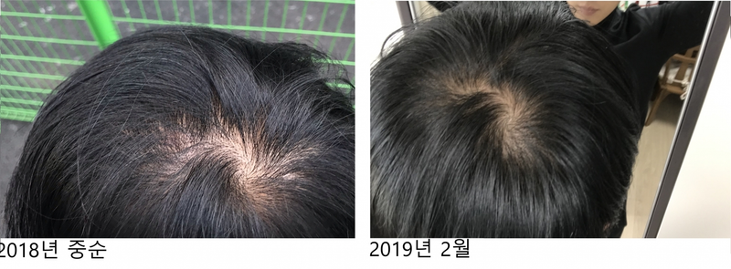 Revised to minoxidil only (16 months) in Kirkland