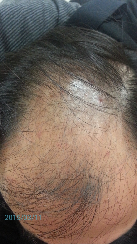 复合处方 6 个月后期