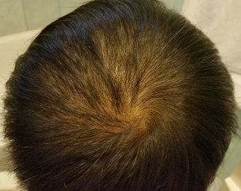 약먹고 한 두달후인데 쉐딩과 더불어 더 안좋아짐