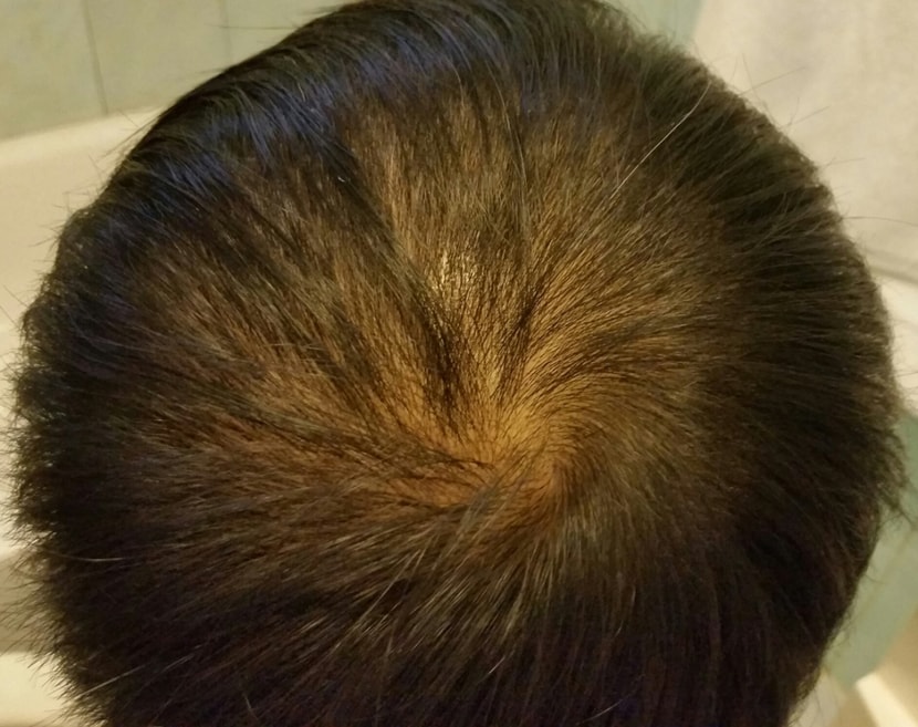 약먹고 한 두달후인데 쉐딩과 더불어 더 안좋아짐