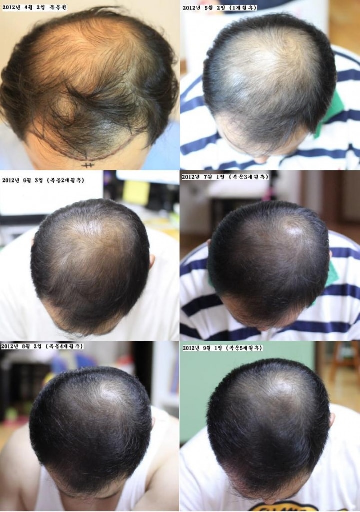 Abodot 3个月 + Propecia Generic 2个月 = 总共5个月后期