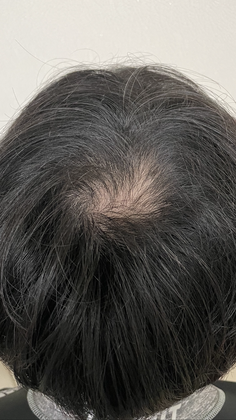 I've been taking Propecia copy medication for 2.5 years, and I've had a sudden burst in the top of my head... advice