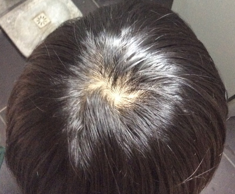 阿伏特+可克米诺地尔+米诺地尔片（高血压药）100d后期。