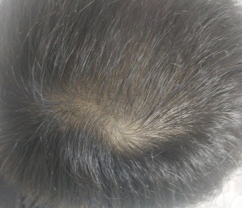 180일 정수리