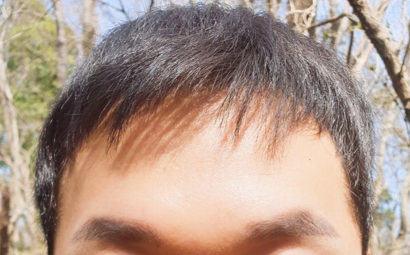 미녹시딜정 시작 직전 29세