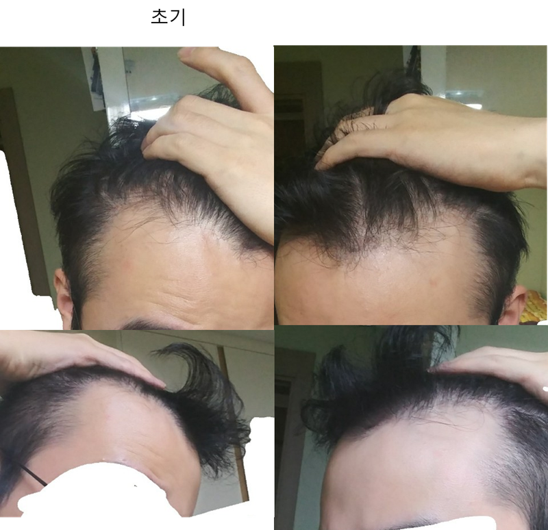 아보다트+미녹시딜도포 2년차 후기