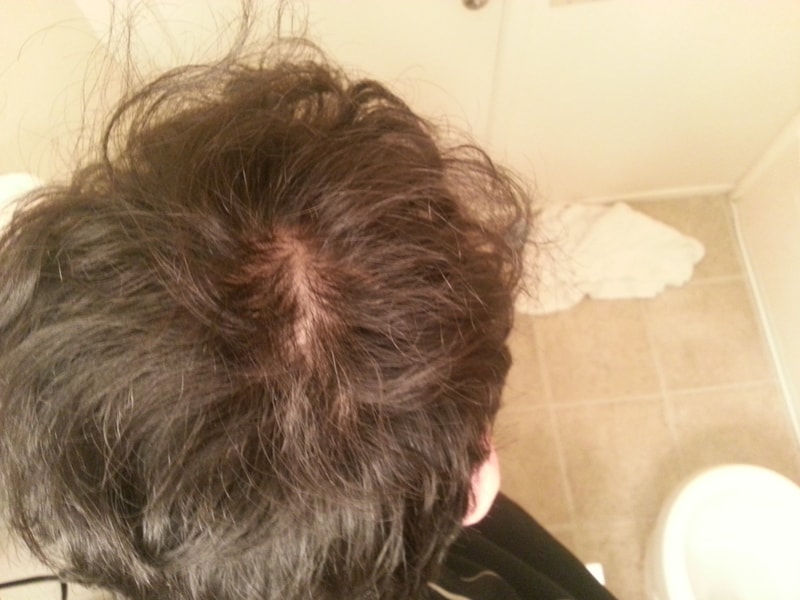 20岁出头1年6个月后期..