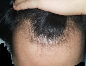 복용 약 1개월