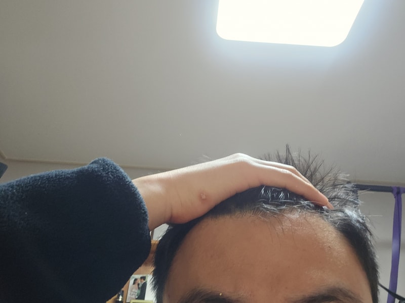 프로페시아 2년후기 m자탈모