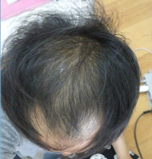 아보 미녹 시작했습니다.