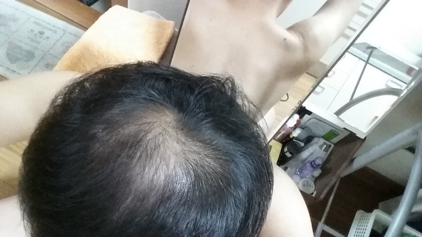 치료1일차