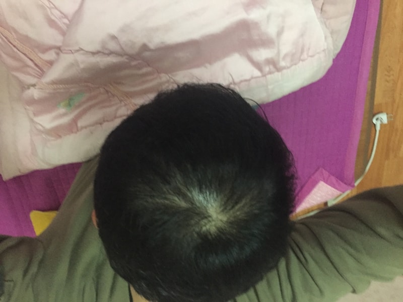 고딩때부터 탈모 두타라이드 두달차 후기입니다