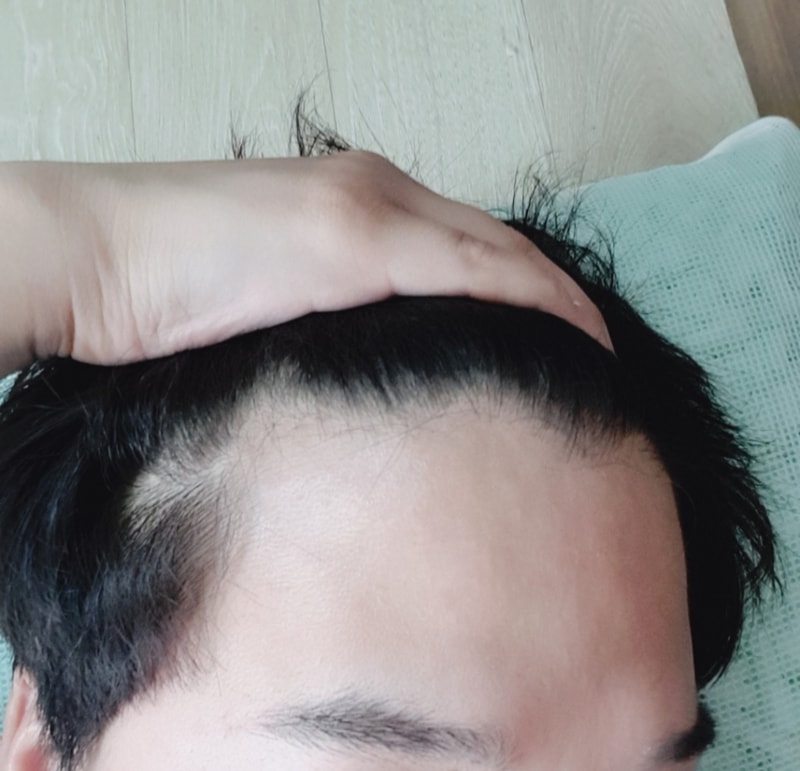 Minoxidil Pinpecia Abodat 2 years
