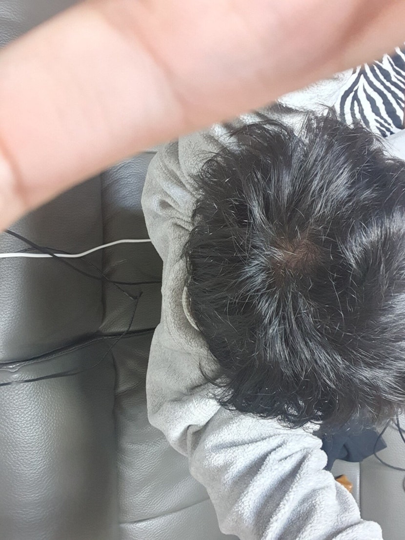 먹고 1년뒤 사진