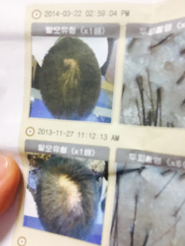 두피클리닉에서 치료받을때 사진파일