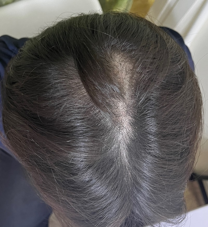 피나계열 2개월차 후기 효과?