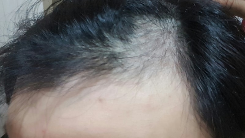 M字脱发成功记（第5个月Pinasterid）